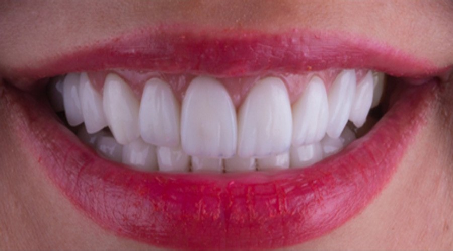 بعد تجميل وزراعة الاسنان فينير 1